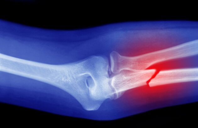 Bone Fracture